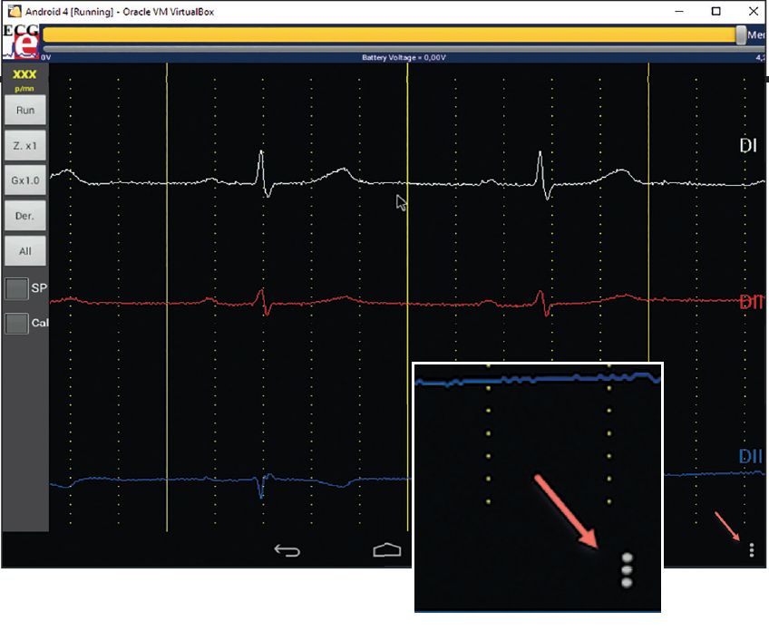 ECG 2 2